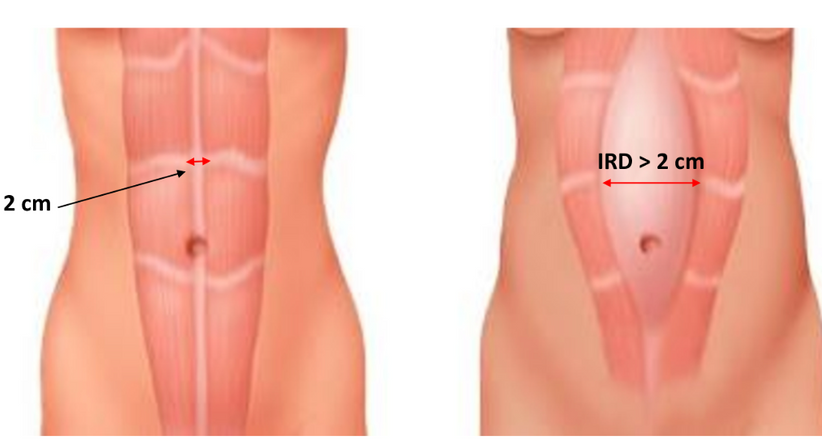 Rektusdiastase   - Univ.-Prof.Dr.  René H. Fortelny, FEBS-AWS - Allgemeinchirurg Wien 1190