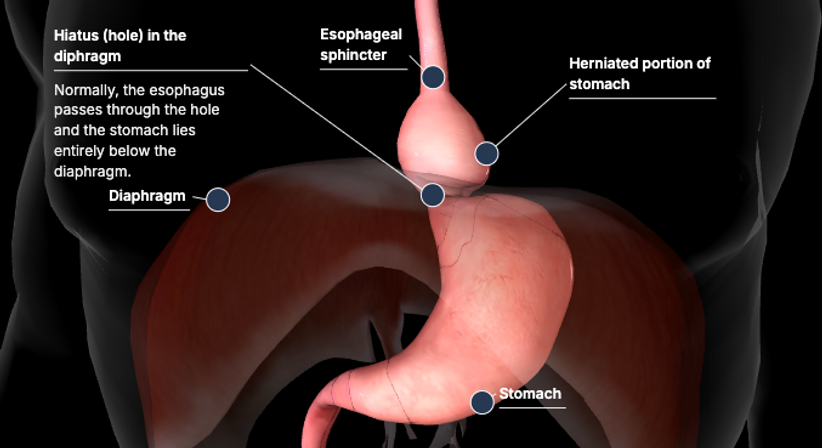 Hiatushernie - Univ.-Prof.Dr.  René H. Fortelny, FEBS-AWS - Allgemeinchirurg Wien 1190