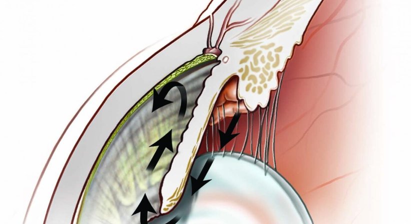 Grüner Star - Dr. Thomas Pfleger - Augenarzt Wien 1130