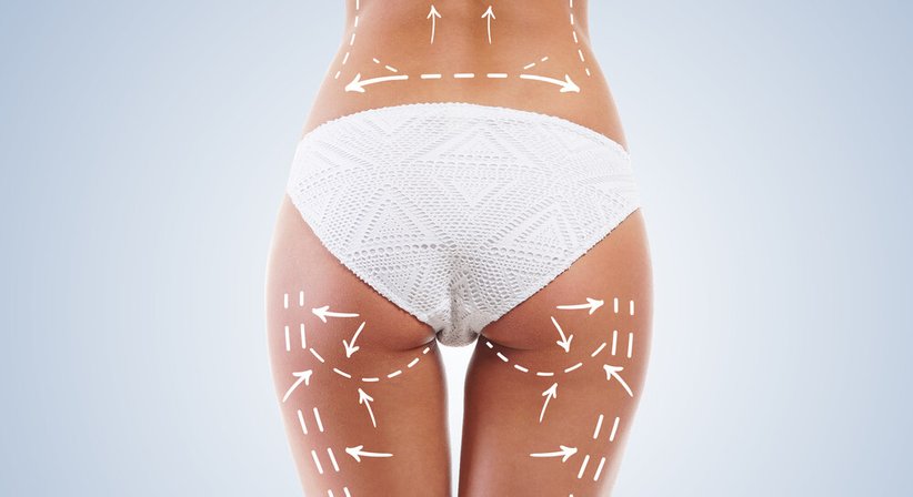 Fettabsaugung (Liposuktion) - Dr. med univ. Christian Wolf, Executive MBA - Plastischer Chirurg Salzburg 5020