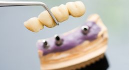 Implantat -