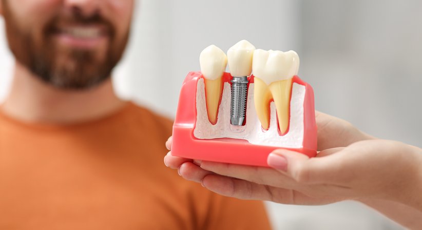 Zahnimplantate - in Zusammenarbeit mit einem namhaften Implantologen - Dr. Sabine Stumvoll - Zahnärztin Wien 1180