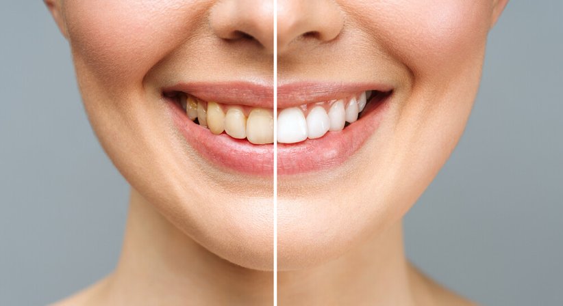 Bleaching - Dr. Sabine Stumvoll - Zahnärztin Wien 1180