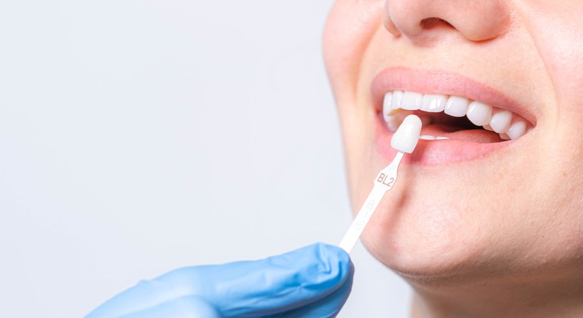 Veneers - Dr. Sabine Stumvoll - Zahnärztin Wien 1180