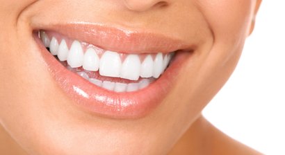 Die Vorteile von Zahnimplantaten auf einen Blick