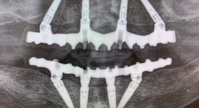 All-on-4, feste Zähne an einem Tag