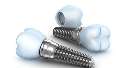 Was sind Zahnimplantate?