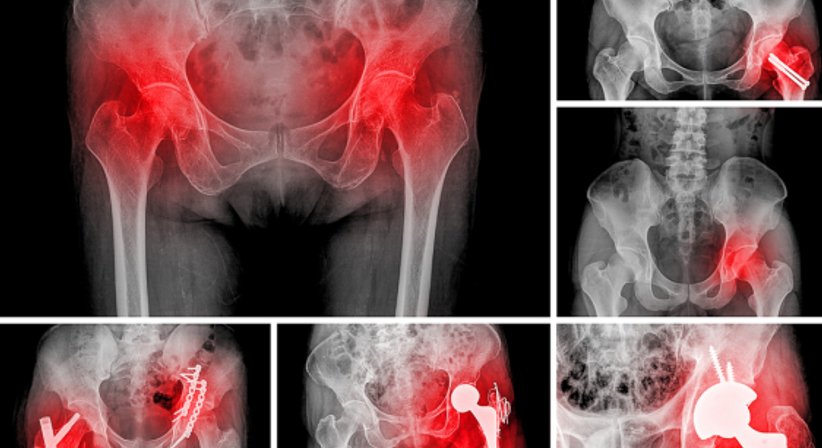 Hüftprothese - OA Dr. Peter Radakovits - Orthopäde Baden 2500