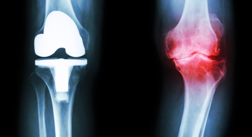 Knieprothese - OA Dr. Peter Radakovits - Orthopäde Baden 2500