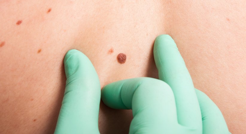 Allgemeine Dermatologie - Dr.med.univ. Alice Jansky - Hautärztin Salzburg 5020