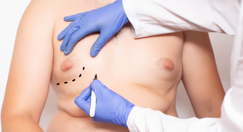 Gynäkomastie - Dr. Otto Riedl, MSc - Plastischer Chirurg Tulln 3430