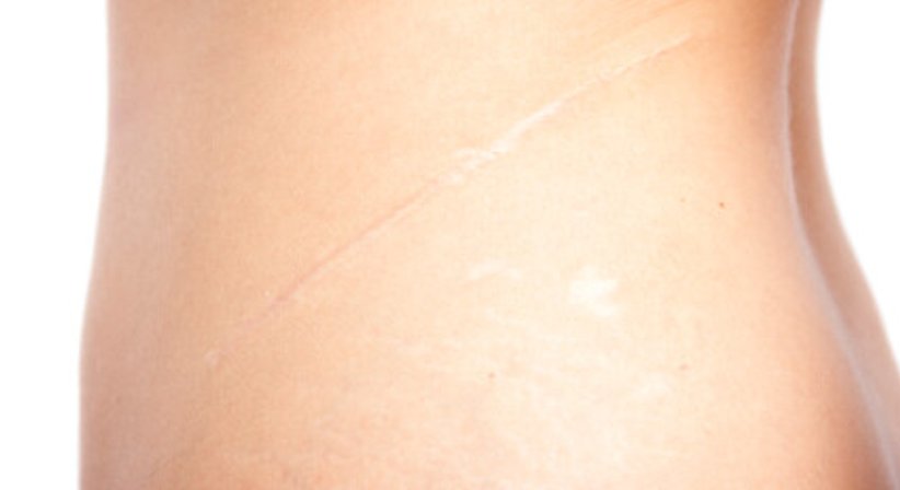 Narbenkorrekturen - Dr. Otto Riedl, MSc - Plastischer Chirurg Tulln 3430