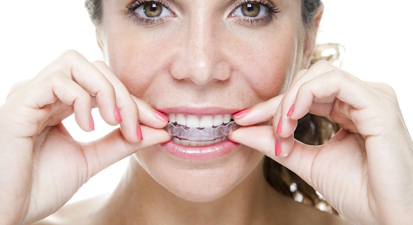 unsichtbare Aligner - Dr. Simon Spönlein - Zahnarzt Wien 1010