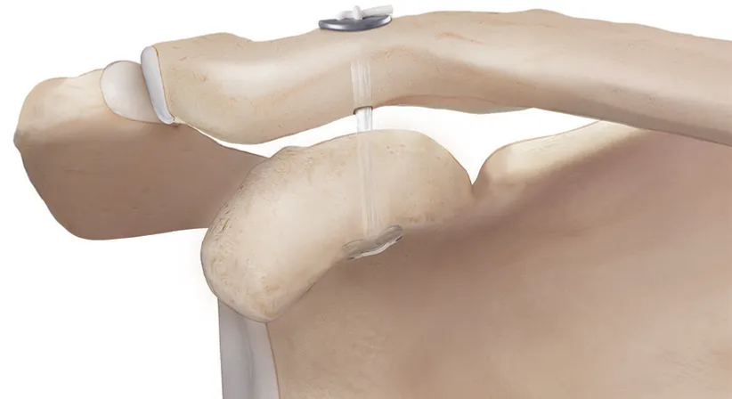 Stabilisierung des Schultereckgelenkes (ACG Rekonstruktion) - OA Dr. Markus Riedl - Orthopäde Wien 1010