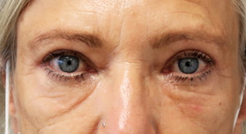 Lidkorrektur - Dr. med. univ. Dani Lutfi - Plastischer Chirurg Wien 1080