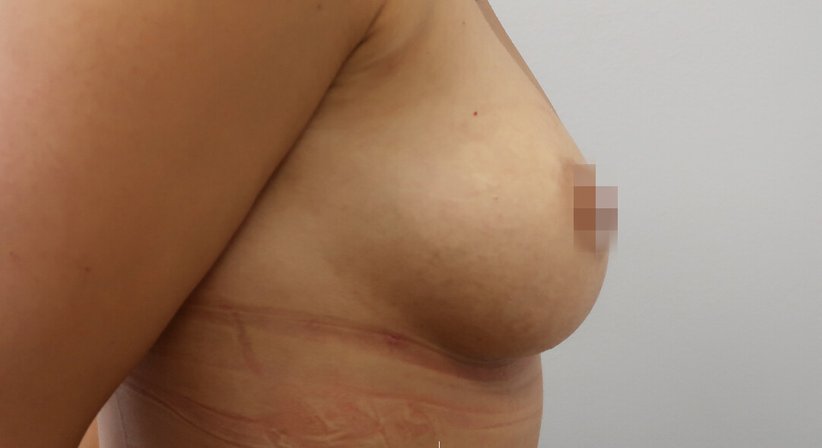 Brustvergörßerung mit Eigenfett
- Dr. med. univ. Dani Lutfi - Plastischer Chirurg Wien 1080