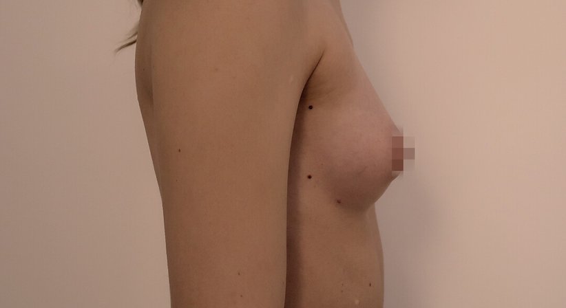 Brustvergörßerung mit Eigenfett
- Dr. med. univ. Dani Lutfi - Plastischer Chirurg Wien 1080