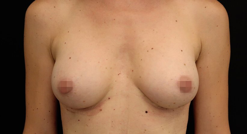 Brustvergrößerung mit Implantaten - Dr. med. univ. Dani Lutfi - Plastischer Chirurg Wien 1080