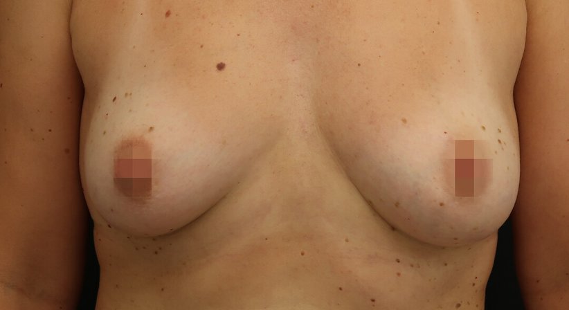 Brustvergörßerung mit Eigenfett
- Dr. med. univ. Dani Lutfi - Plastischer Chirurg Wien 1080