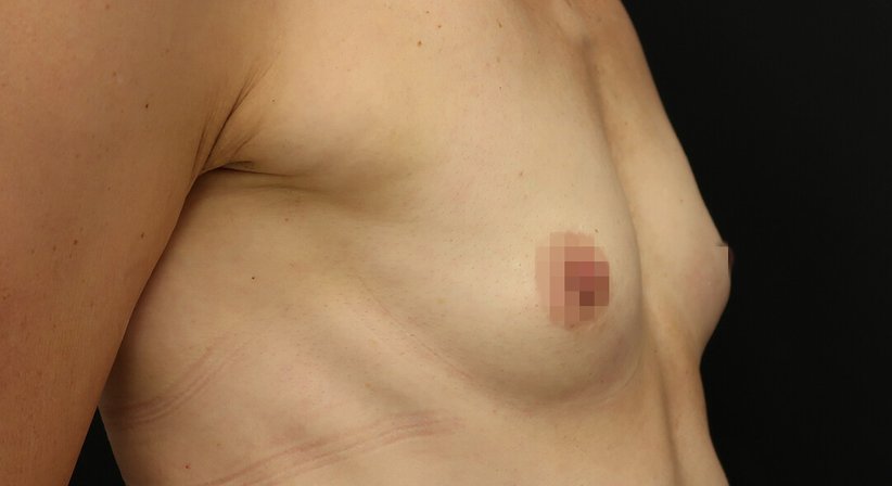Brustvergörßerung mit Eigenfett
- Dr. med. univ. Dani Lutfi - Plastischer Chirurg Wien 1080