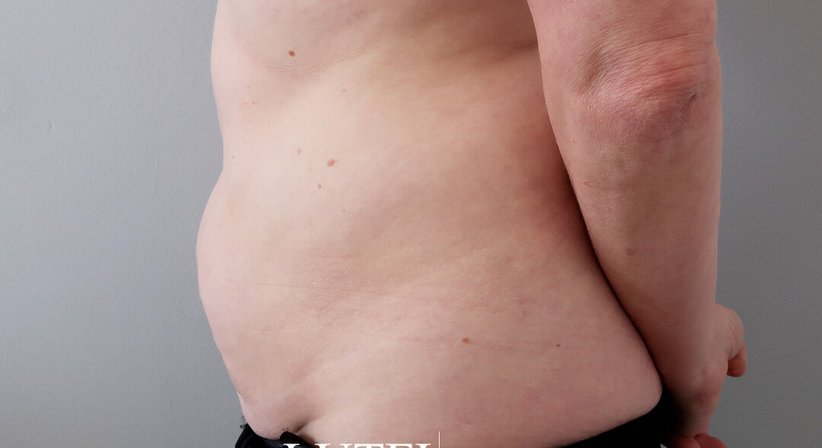 Fettabsaugung - Dr. med. univ. Dani Lutfi - Plastischer Chirurg Wien 1080