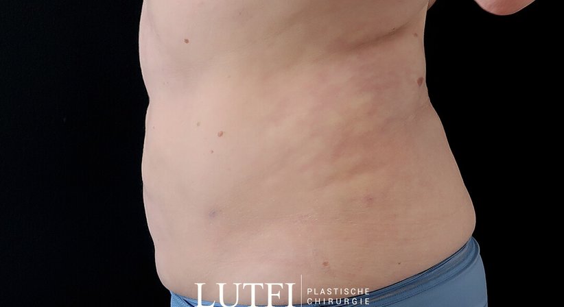 Fettabsaugung - Dr. med. univ. Dani Lutfi - Plastischer Chirurg Wien 1080