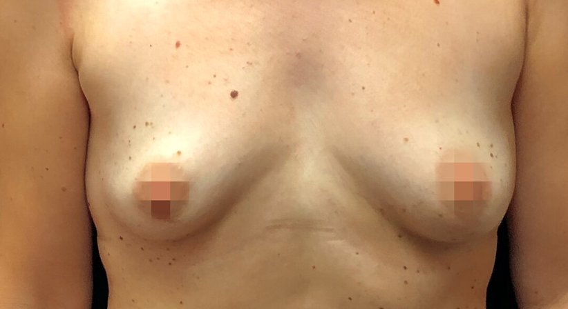 Brustvergörßerung mit Eigenfett
- Dr. med. univ. Dani Lutfi - Plastischer Chirurg Wien 1080
