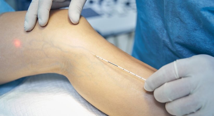 Krampfadernoperation/Varizenoperation - Dr. Kurosch Borhanian - Allgemeinchirurg/Viszeralchirurg Salzburg 5020