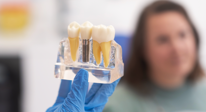 Implantologie / Zahnimplantate - Dr. Barbara Susanne Matejka - Zahnärztin Wien 1070