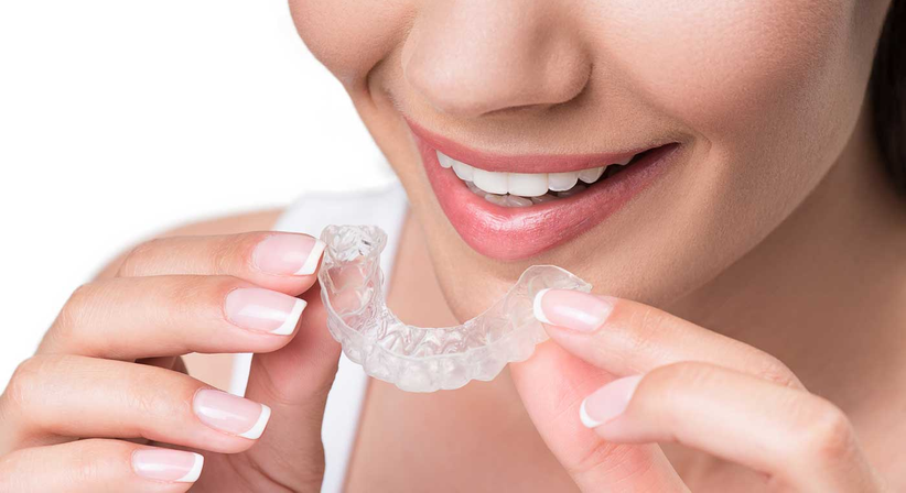 Aligner - Dr. Katharina Sas - Zahnärztin Wien 1120