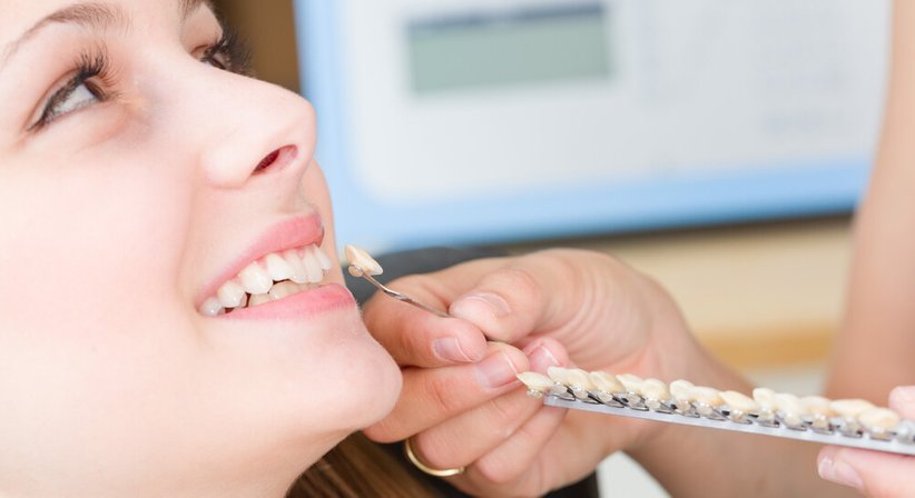 Veneers - Dr. Andreas Zimmermann - Zahnarzt Wien 1080