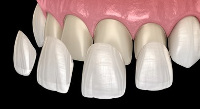 Veneers