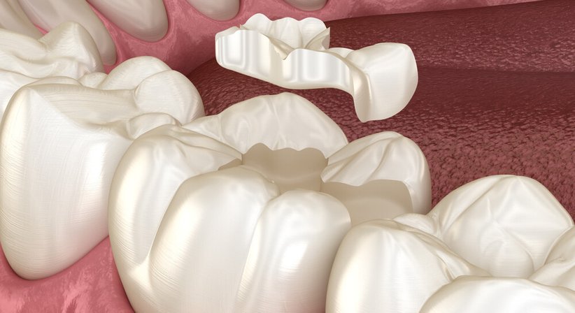 Inlay / Onlay / Overlay - Dr. Elke Lenotti - Zahnärztin Wien 1020