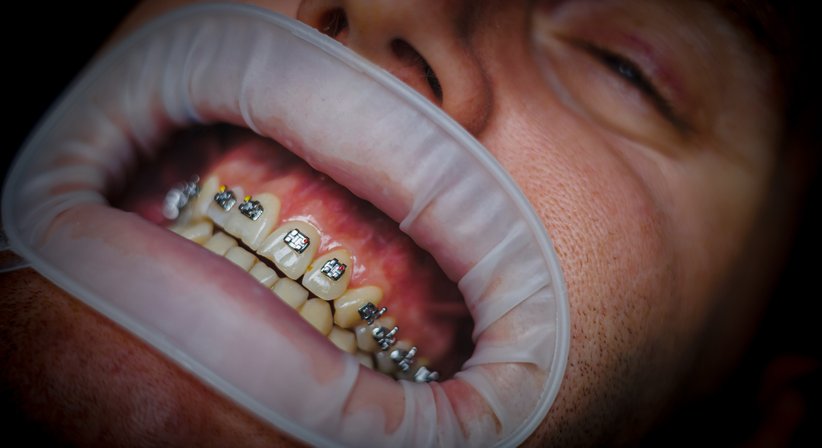 Gratiszahnpange  - Dr. med. dent. Karan Sharma, MSc - Zahnarzt Salzburg 5020