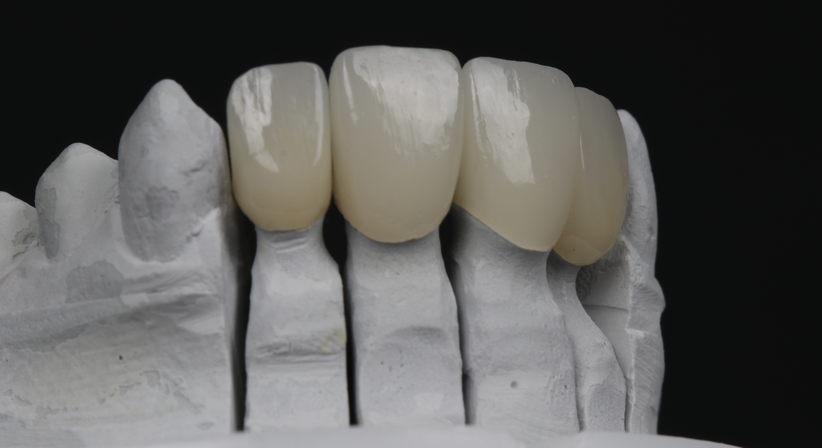 Kronen & Brücken - Dr. Alexander Puchner, MSc - Zahnarzt Neunkirchen 2620