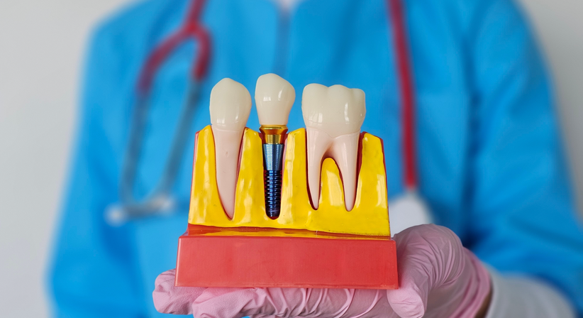 Zahnimplantate - Dr. Alexander Puchner, MSc - Zahnarzt Neunkirchen 2620