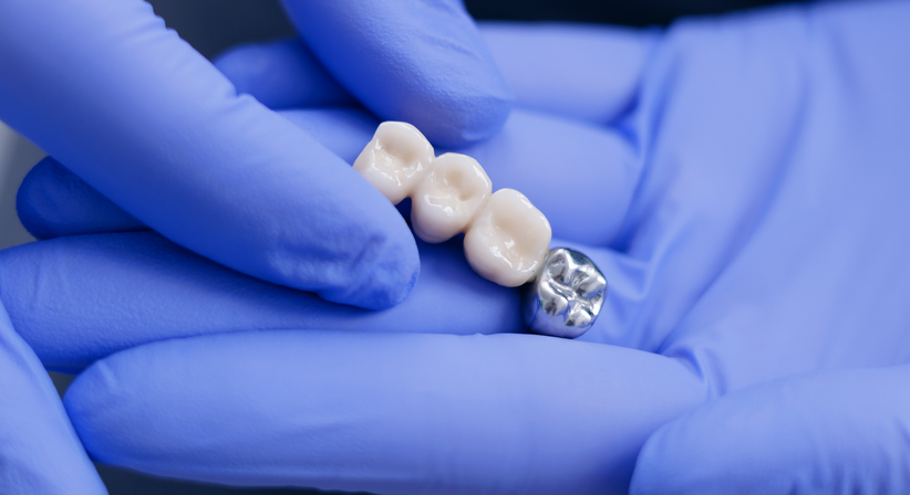 Inlay - Dr. Alexander Puchner, MSc - Zahnarzt Neunkirchen 2620