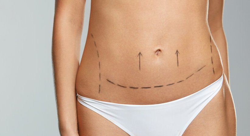 Bauchstraffung - Dr. Matthias Kolloros - Plastischer Chirurg Klagenfurt 9020