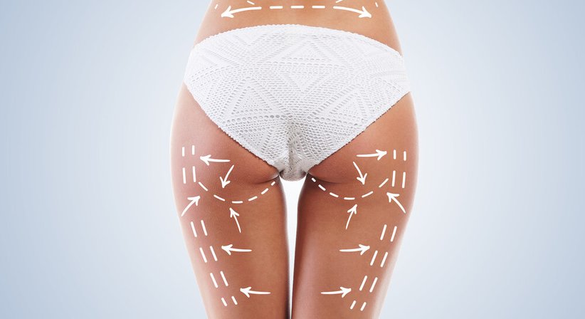 Oberschenkelstraffung - Dr. Matthias Kolloros - Plastischer Chirurg Klagenfurt 9020