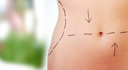 Bauchdeckenstraffung