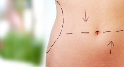 Bauchdeckenstraffung