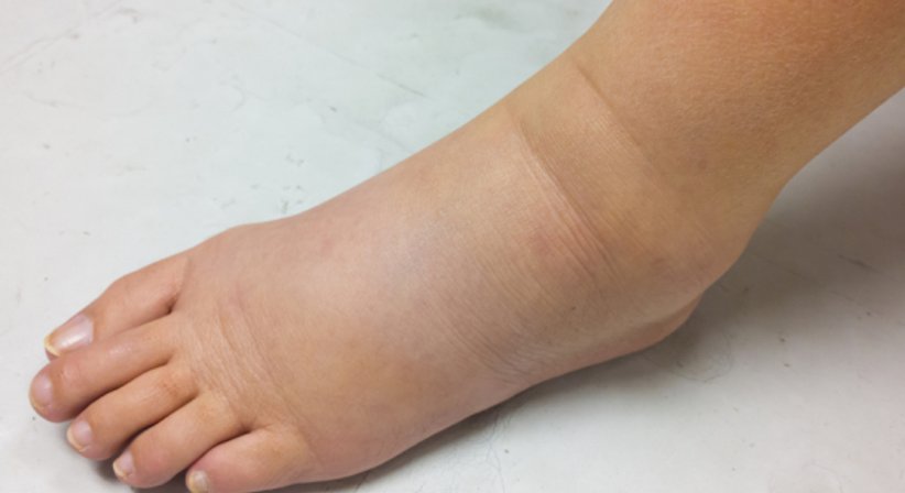 Ödeme - Prof. Dr. Gürkan Sengölge - Internist Gablitz 3003