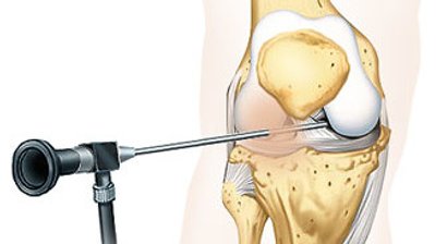 Arthroskopie, Meniskusriss, Kreuzbandriss