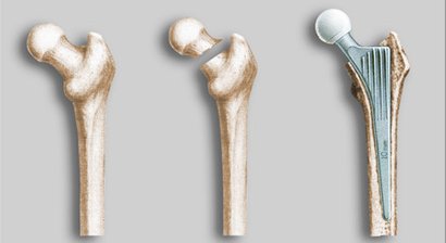 Hüftgelenkprothese, Minimal Invasive