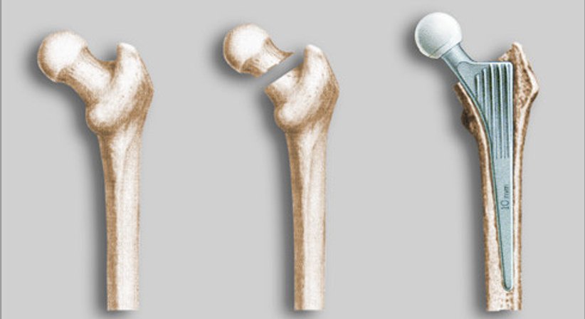 Hüftgelenkprothese, Minimal Invasive - OA Dr. Michael Yaser Akta - Orthopäde Wien 1070