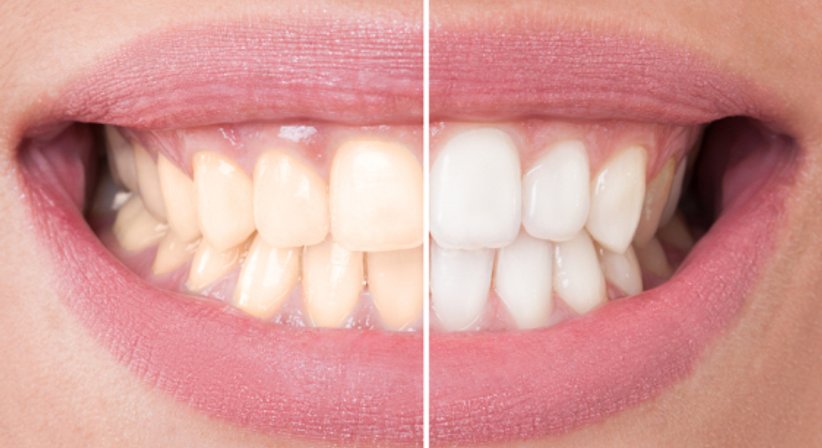 Bleaching - Dr. Martin Ladentrog - Zahnarzt Graz 8010