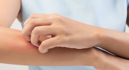 Psoriasis -