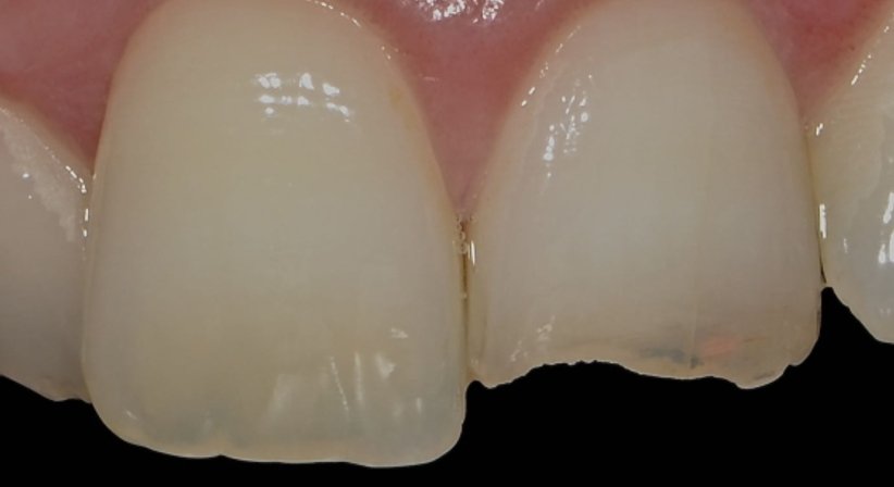 Zahnästhetik - Zahnärztin Petra Sulik, M.Sc. - Zahnärztin Schwanenstadt 4690