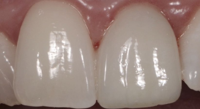 Zahnästhetik - Zahnärztin Petra Sulik, M.Sc. - Zahnärztin Schwanenstadt 4690