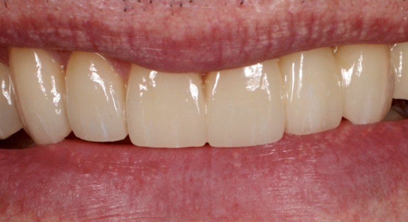 Zahnästhetik - Zahnärztin Petra Sulik, M.Sc. - Zahnärztin Schwanenstadt 4690